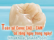 3.Răng to�n sứ Cerec CAD-CAM c� răng ngay trong ng�y