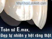 2.Răng to�n sứ cao cấp E.max Press - Thụy Sĩ - Đẹp tự nhi�n như răng thật
