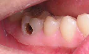 sử dụng c&aacute;c sản phẩm bảo vệ răng c&oacute; chứa flor sẽ g&oacute;p ph&agrave;n hạn chế s&acirc;u răng