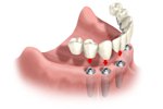 Implant_toan_ham