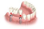 caurang_implant