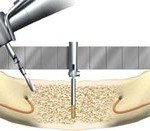 cay_mini_implant_nha_khoa