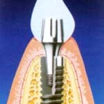implant1