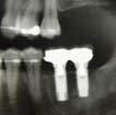 implants_xray implants_xray