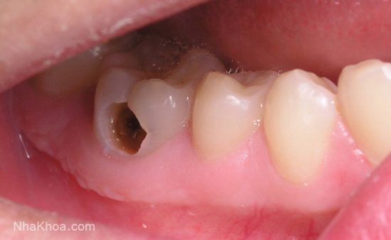 Vi khuẩn ăn mòn tạo các lỗ sâu trên răng