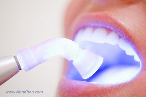 Tẩy trắng răng tại Nha khoa bằng đèn LED