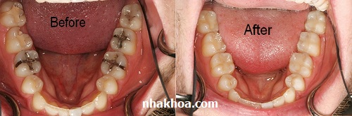 Đau răng có thể xảy ra nếu nha sĩ không làm đúng kỹ thuật