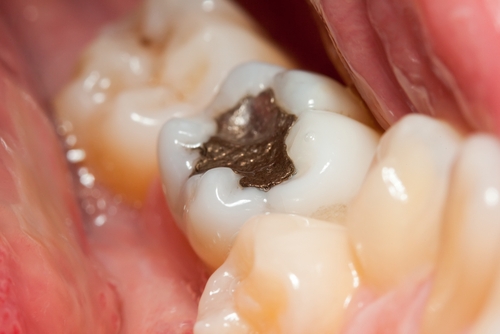 Vì không có màu sắc giống răng thật nên Amalgam chủ yếu sử dụng cho răng hàm