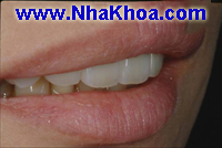 Rang duoc cay ghep implant