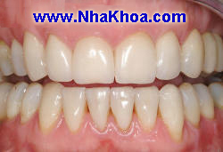 Ham duoi ghep 4 implant 