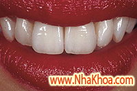 Implant cho trường hợp mất răng hoàn toàn như thế nào? Ham rang duoc cay ghep implant hoan toan