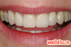 Implant cho trường hợp mất nhiều răng như thế nào? Sau khi cay ghep implant