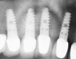 Nguyên nhân khiến việc cấy ghép implant bị thất bại Anh chup cay ghep implant