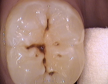  nguoi ta da chung minh duoc rang thuc an co nhieu duong se anh huong toi sau rang, nhung nguoi an chu yeu la mo va thit lai rat it bi sau rang.