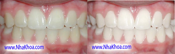 Rang sau khi duoc thuc hien phuong phap tay trang rang.