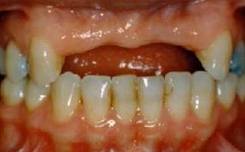 co nhieu truong hop do xuong nen khong the dat implant khi mat rang