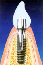 Cấy ghép implant cay ghep implant - phuong phap dieu tri moi