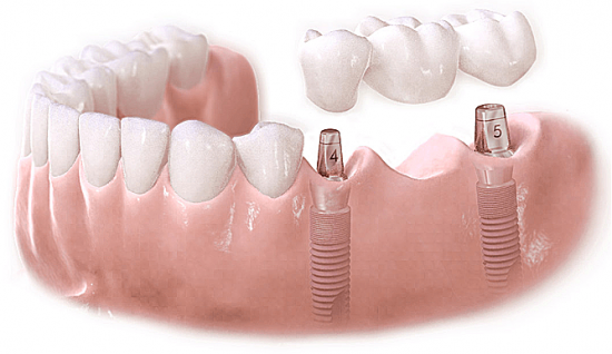 Chăm sóc răng implant như thế nào? cong nghe cay ghep implant