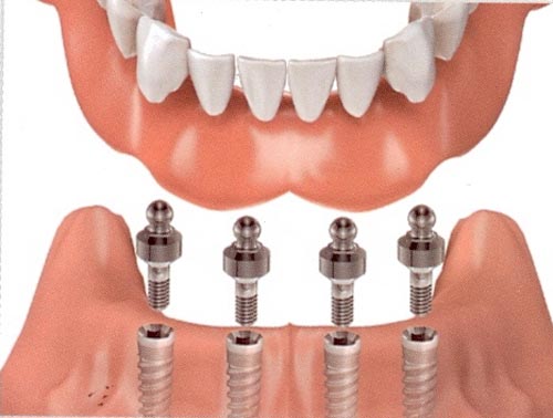 Chăm sóc răng implant như thế nào? Cong nghe cay ghep implant