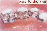 hinh anh truoc tram rang nha khoa tham my