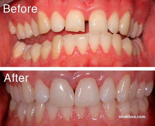 Các trường hợp răng thưa cũng có thể áp dụng phương pháp này