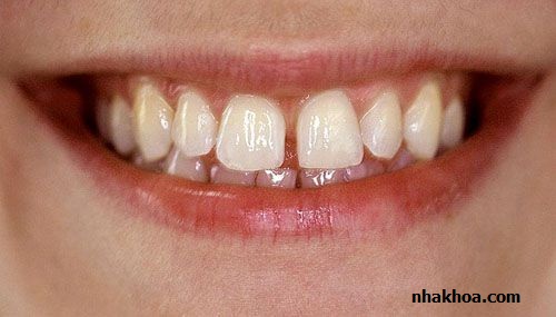 Răng thưa là trường hợp khá phổ biến và có thể khắc phục nhờ trám răng