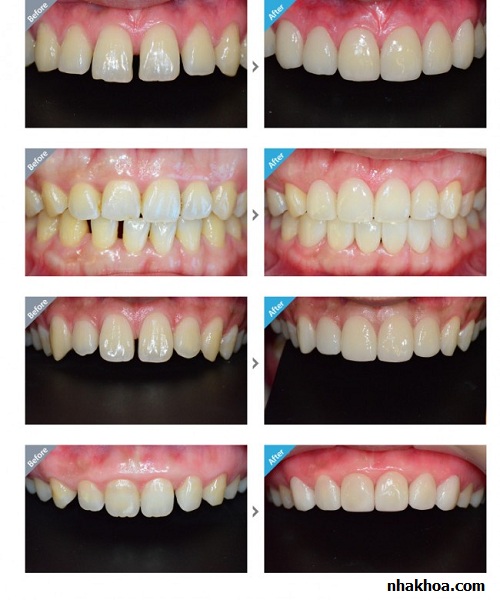 Các trường hợp răng thưa điều trị thành công bằng trám răng thẩm mỹ