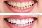 Lưu ý trước và sau khi tẩy trắng răng